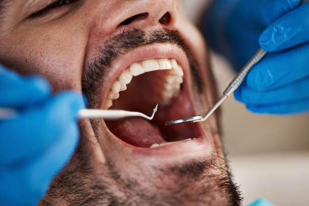 Best Emergency Root Canal Treatment in Stevens Point, WI